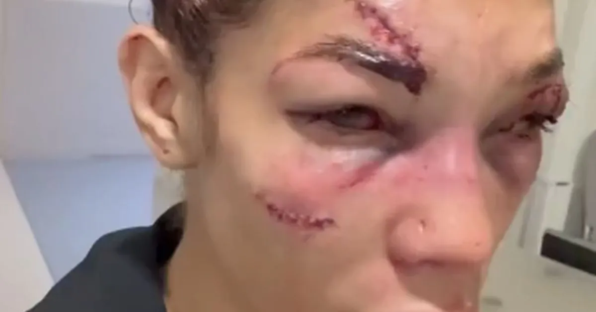 UZNEMIRUJUĆE! Evo kako izgleda Sofija Montenegro posle jezivih batina u Parizu, lice joj potpuno unakaženo!