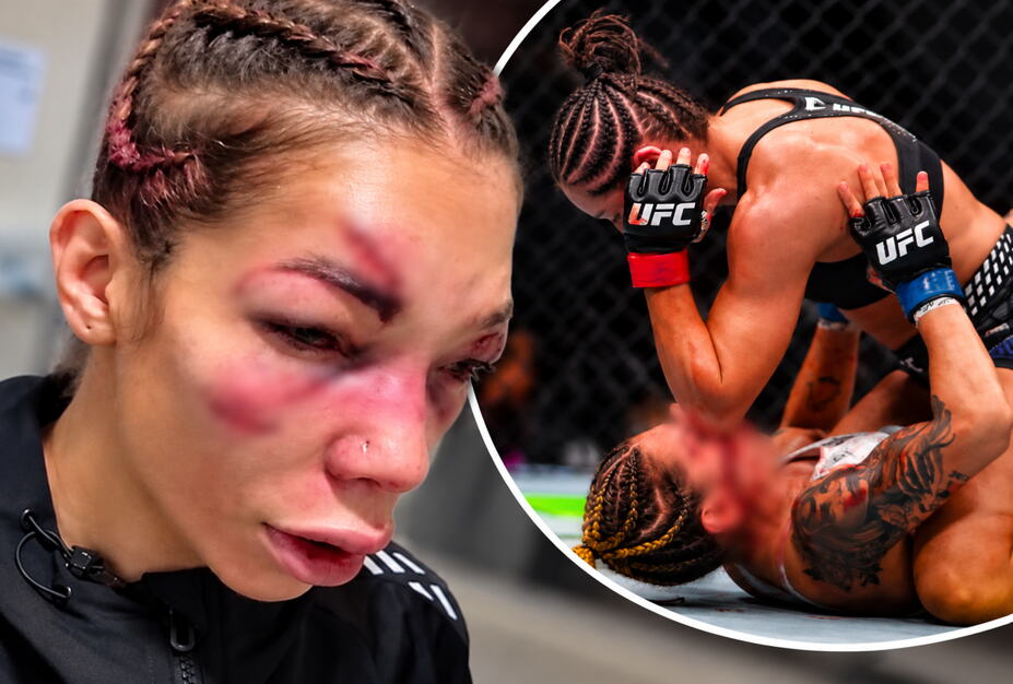 UZNEMIRUJUĆE! SOFIJI JE LICE UNAKAŽENO! Posle krvavog UFC debija pokazala JEZIVE posledice prizor nije za one sa slabijim stomakom! (VIDEO, FOTO)
